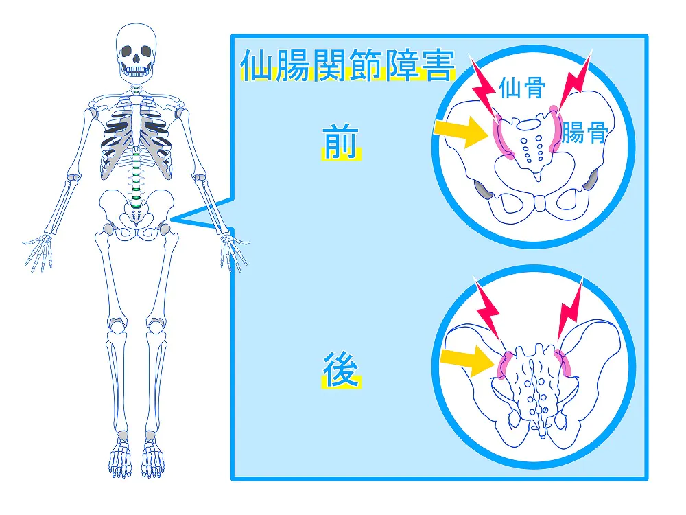 仙腸関節障害