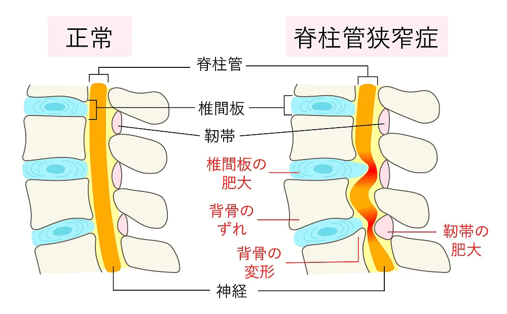 脊柱管狭窄症